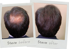 Sure Thik Hair Thickening Fiber treatment Before and After